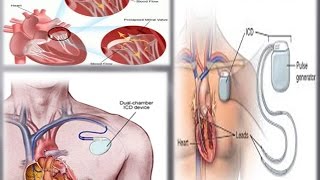 How to Live With an Implantable Cardioverter Defibrillator [upl. by Rida]