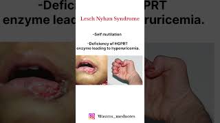 Lesch Nyhan Syndrome High yield Topic  🔥🔥💯💯 fmge shorts [upl. by Adah838]