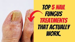 Top 5 Nail Fungus Treatments That Actually Work [upl. by Acirrej379]