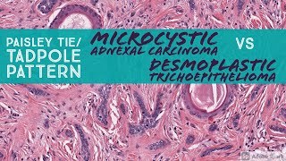 Microcystic Adnexal Carcinoma vs Desmoplastic Trichoepithelioma Paisley TieTadpole Pattern [upl. by Franzen756]