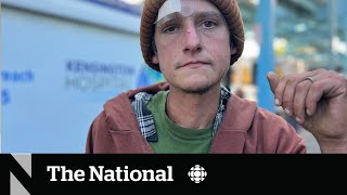 How a fleshrotting ‘zombie drug’ is complicating the overdose crisis [upl. by Maroney]