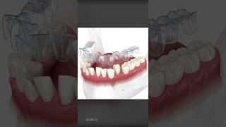 How Does Invisalign Aligners Work To Straighten Teeth [upl. by Aisinoid929]