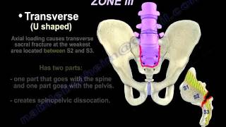 Foramnial injection for L5S1 vertebra [upl. by Arreip816]