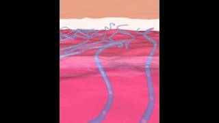 SPIDER VEINS animation how spider veins are formed [upl. by Mikaela544]