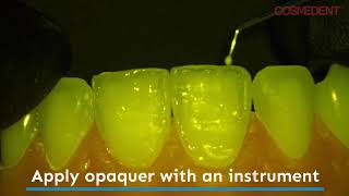 Enhancing the Halo Effect on Composite Restorations with Creative Color Opaquers [upl. by Herrod]