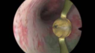 Rollerball Endometrial Ablation  Virtual Reality Simulation for Endoscopic Surgery [upl. by Tigram]