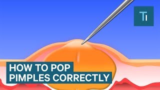 Dr Pimple Popper Teaches Us How To Remove A Blackhead  Skin Care AtoZ  TODAY [upl. by Marje332]