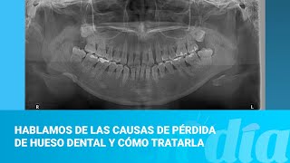 Hablamos de las causas de pérdida de hueso dental y cómo tratarla [upl. by Jb]