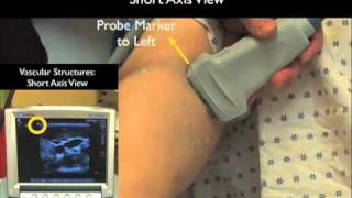 How to Peripheral Venous Access Under Ultrasound Guidance Case Study Part 1 [upl. by Hardunn]