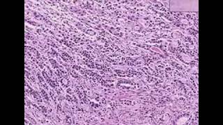 Histopathology StomachAdenocarcinoma [upl. by Betz485]