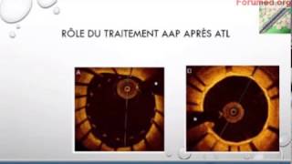 Association antiagrégant plaquettaire anticoagulant après pose de stent 2017 [upl. by Gee]