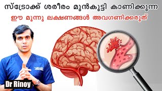 സ്ട്രോക്ക് ശരീരം മുൻകൂട്ടി കാണിക്കുന്ന ഈ മൂന്നു ലക്ഷണങ്ങൾ അവഗണിക്കരുത് Dr Rinoy Stroke [upl. by Manella]