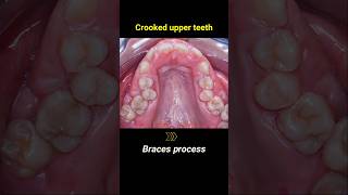 How to fix crooked upper teeth with braces orthodontist braces dentist crookedteeth [upl. by Charla]