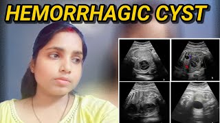 I am suffering from hemrroghic cyst on the ovary [upl. by Houston147]