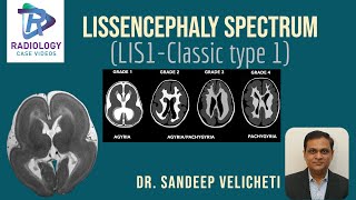 Lissencephaly SpectrumClassic Type1Sandeep VelichetIunderstanding lissencephaly microscopic level [upl. by Ynohtnacram]