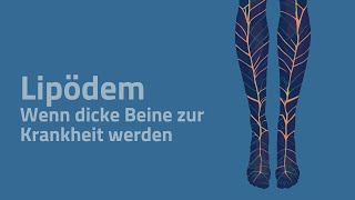 Lipödem  Wenn dicke Beine zur Krankheit werden [upl. by Eniawd]