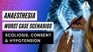 Scoliosis Consent and Hypotension  Anaesthesia Worst Case Scenarios anesthesiology anesthesia [upl. by Gavra]