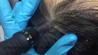 Undiscovered gem for hair loss  DERMEDICS Meso Hair  derma pen microneedling singapore review [upl. by Henryson695]