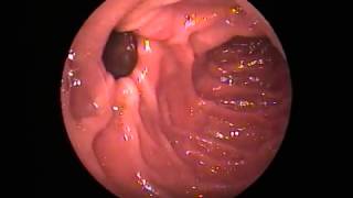 Peripapillary duodenal diverticulum [upl. by Yorgerg]