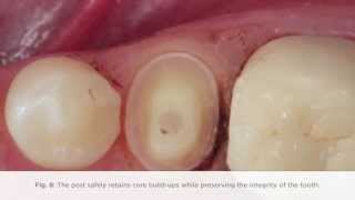 How to complete a post procedure using FibreKleer 4x Fiber Posts [upl. by Deacon]