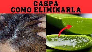 5 SOLUCIONES Efectivas Para La CASPA y Comezon en el Cabello [upl. by Ahsir887]