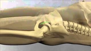 Anterior Approach Hip Replacement [upl. by Acilegna]