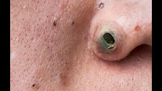 Nose Blackheads Chin Zits and Biggest Pimples  Top 10 Searches [upl. by Linoel353]