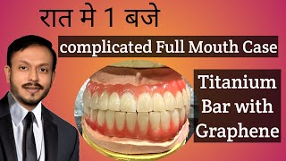 रात को 1 बजे Fixing teeth on implants  complicated Full mouth Implant case [upl. by Atena]