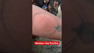 Mantoux Test Result Positive shortsyoutubeshorts virulshorts [upl. by Saxen]