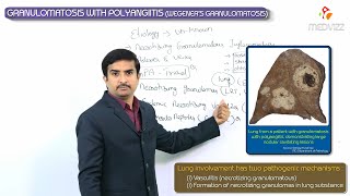 Granulomatosis with polyangiitis  Wegeners granulomatosis  Usmle step 1 vascular Pathology [upl. by Karia637]