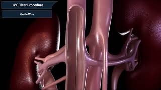 Inferior vena cava filter procedure [upl. by Baerman]