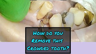 How to Extract a Crowded Tooth [upl. by Sackman]