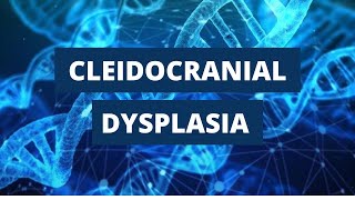 Cleidocranial Dysplasia Introduction Etiology Clinical Features and Treatment [upl. by Giarg607]