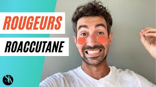 Comment Eviter Les Rougeurs Persistantes Dues Au Roaccutane Flush Erythrose Histamine [upl. by Epuladaug631]