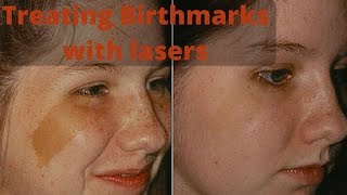 How to treat birthmarks [upl. by Eisele338]