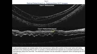 Detecting Retinal Lesions with OCT  Dr Jerome Sherman [upl. by Eah]