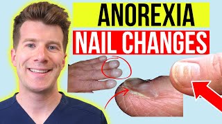 6 finger nail changes seen in ANOREXIA  Doctor explains [upl. by Archibaldo70]