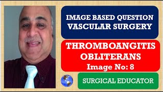 THROMBOANGITIS OBLITERANS  VASCULAR SURGERY  Image Based Question [upl. by Nattirb]