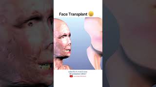 Face Transplant surgery 🎭 [upl. by Mehta]