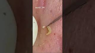 Pickel Ausdrücken Spa  Blackheads Akne amp Mitesser entfernen 🔴 82 [upl. by Balduin]