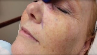 Dermabrasion Scar Removal Treatment [upl. by Osmund280]