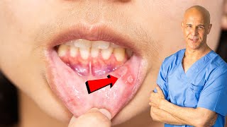 Best Supplement for Canker Sores [upl. by Heron]