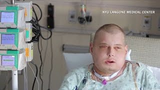 quotMost extensivequot full face transplant patient recovering [upl. by Ellehcin]