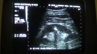 RENAL PARENCHYMAL CALCIFICATION vs NEPHROLITHIASIS [upl. by Algar]