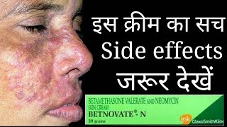 The Shoking Truth Of Betnovate N Cream Betnovate n cream Review and Side effects [upl. by Lynd]