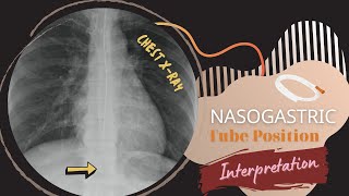 Chest Xray Nasogastric Tube Position Interpretation [upl. by Arretal]