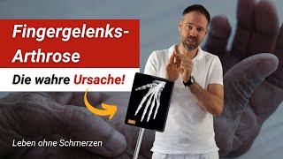 FingergelenksArthrose ⚡ Der wahre Grund für Deine Fingerschmerzen Es liegt an Deinem Verhalten [upl. by Alyn]