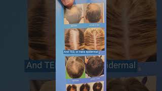 Hair Loss Treatment  Alma TED Ultrasound  HairLossAwarenessMonth [upl. by Mali]