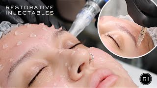 EXOSOME SKIN REJUVENATION  Microneedling with Exosomes  Regenerative Therapy [upl. by Connelly]