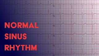 Normal Sinus Rhythm  EKG ECG Interpretation [upl. by Oppen608]